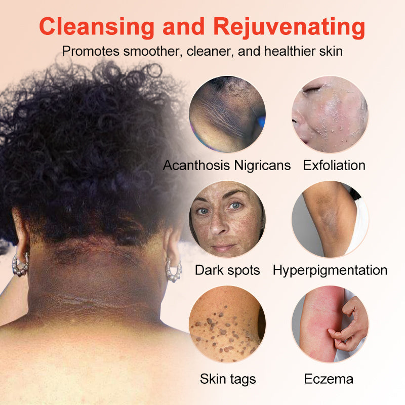 Purifying Exfoliating Gel for Acanthosis Nigricans, Exfoliation, Dark Spots, Skin Tags, Eczema